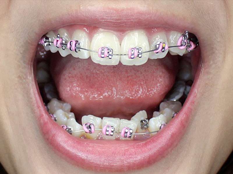 Quá trình niềng răng khểnh gồm nhiều bước phước tạp