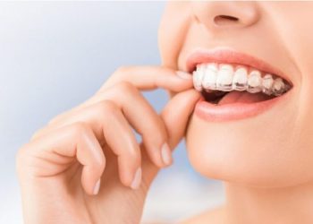 Tìm hiểu các loại niềng răng trong suốt