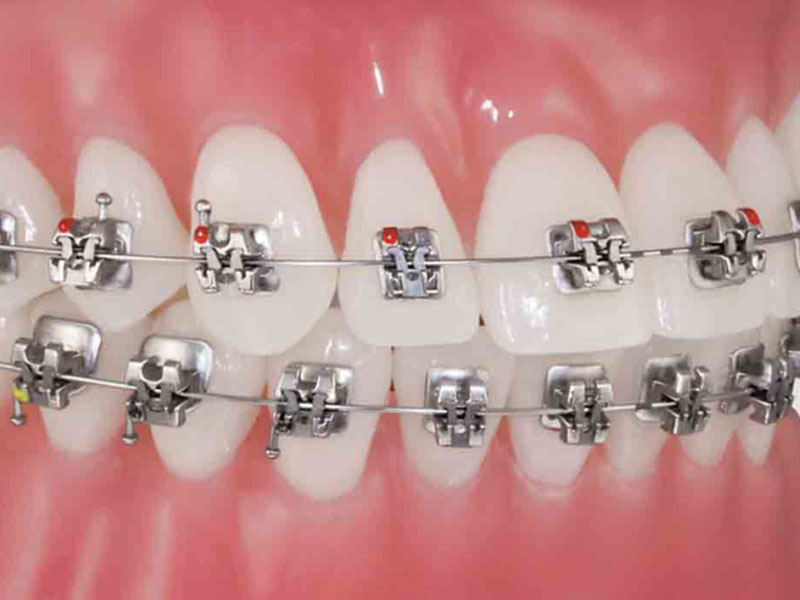 Trong các loại niềng răng hiện nay sử dụng mắc cài kim loại là phương pháp phổ biến nhất