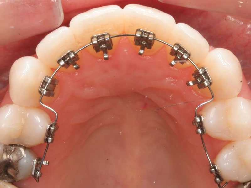 Trong các loại niềng răng hiện nay, phương pháp đặt mắc cài ở mặt trong của răng được nhiều người lựa chọn