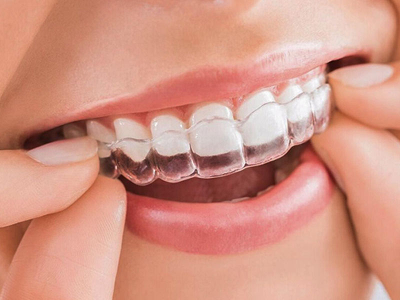 Hệ thống khay niềng bằng nhựa giúp định hình và chỉnh răng hiệu quả