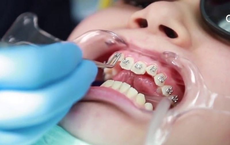 Tùy vào từng loại hình niềng răng và đơn vị tiến hành mà chi phí thực hiện sẽ khác nhau
