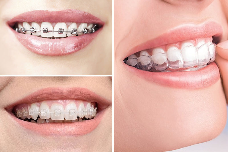Dây niềng sức là 1 trong top 5 loại dây cung niềng răng phổ biến hiện nay
