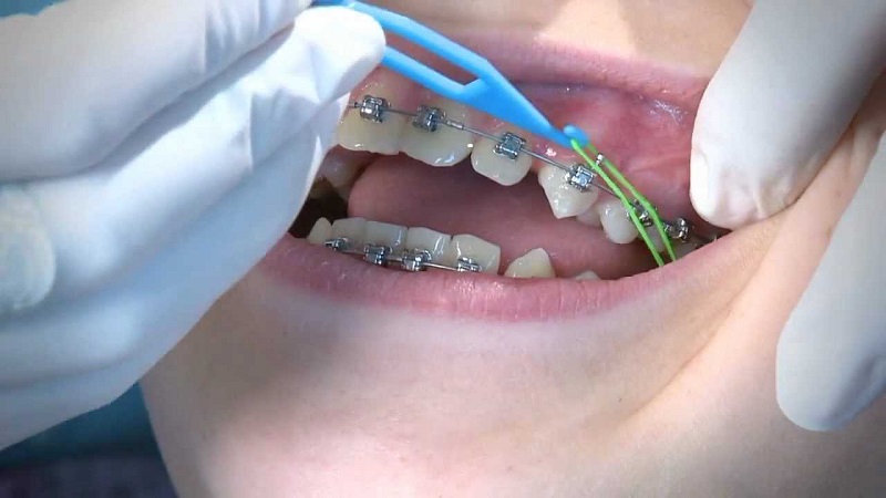 Thun niềng răng là một khí cụ trong chỉnh nha