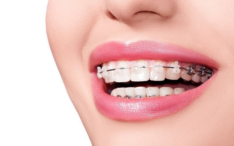 Niềng răng giúp cải thiện các vấn đề về răng lệch lạc, răng mọc không như ý muốn