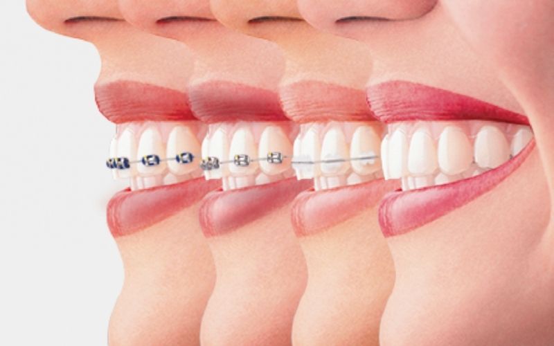 Chi phí niềng răng sẽ phụ thuộc chủ yếu vào loại mắc cài bạn sẽ lựa chọn