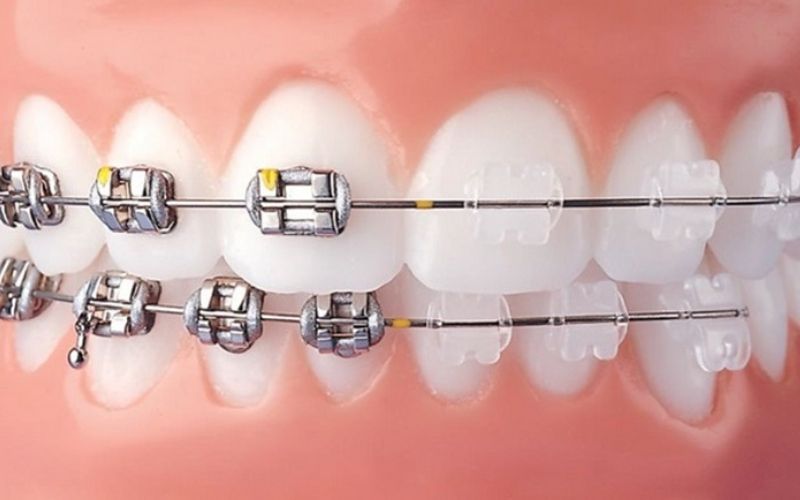 Niềng răng mắc cài là phương pháp niềng phổ biến nhất hiện tại