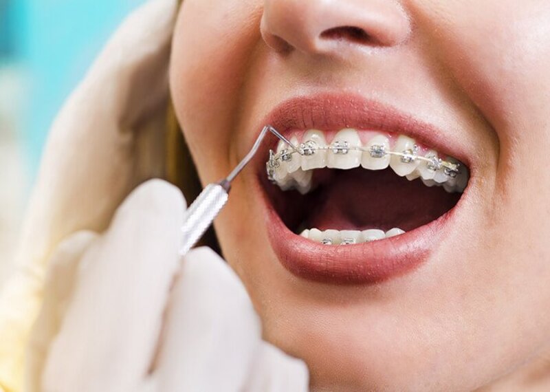 Niềng răng là phương pháp phù hợp cho cả người lớn và trẻ em 