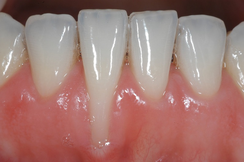 Niềng răng bị tụt lợi là nỗi lo của rất nhiều người có nhu cầu chỉnh nha