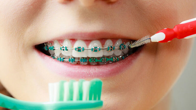 Cha mẹ nên lưu ý cách vệ sinh răng miệng khi niềng răng cho trẻ