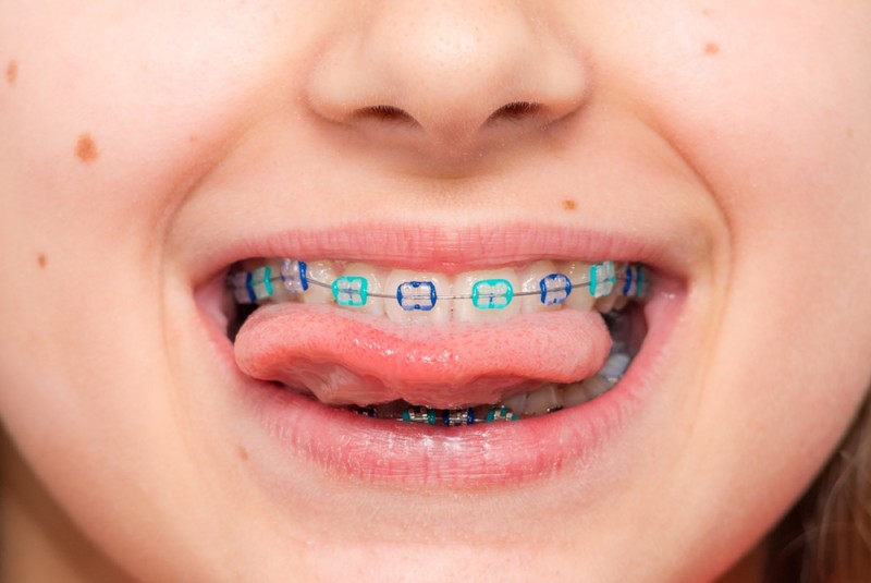 Việc niềng răng cho trẻ từ sớm mang lại rất nhiều lợi ích 