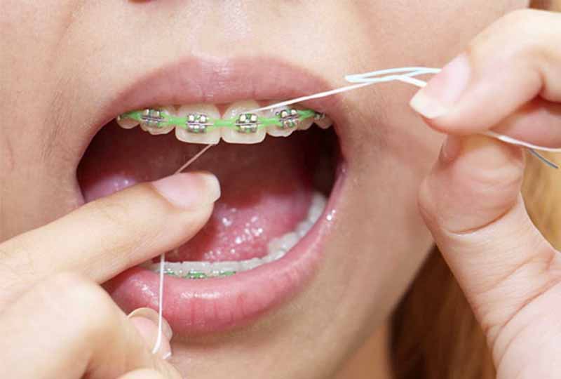 Chăm sóc răng miệng sạch sẽ sau niềng