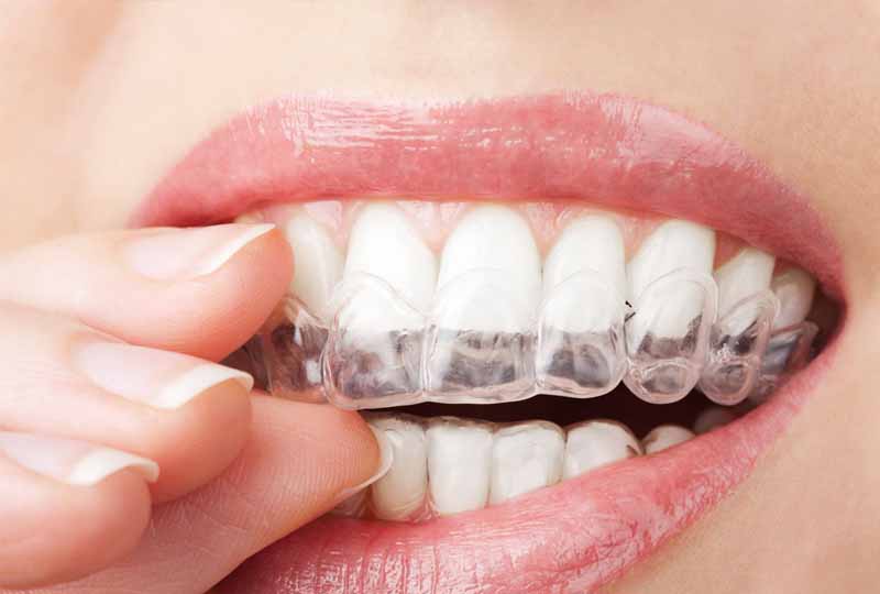 Đeo hàm duy trì giúp răng được ổn định sai niềng