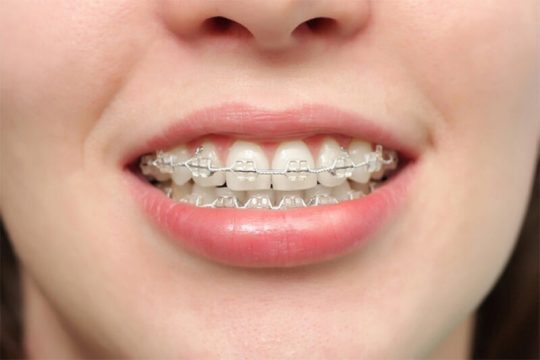 Thời gian niềng răng hô hàm phụ thuộc vào rất nhiều yếu tố