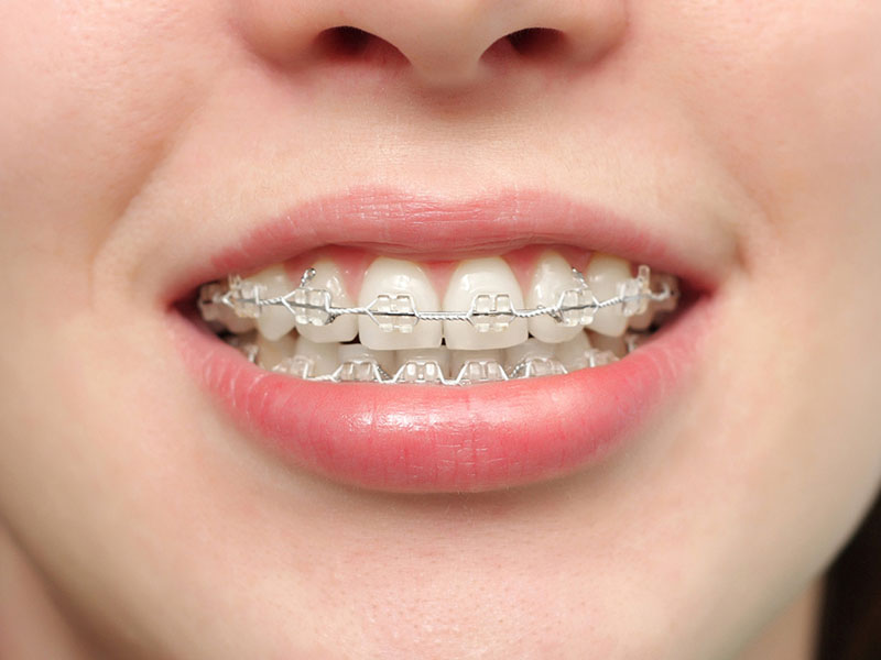 Chỉnh nha bằng mắc cài sứ giúp cải thiện nhiều khiếm khuyết về răng