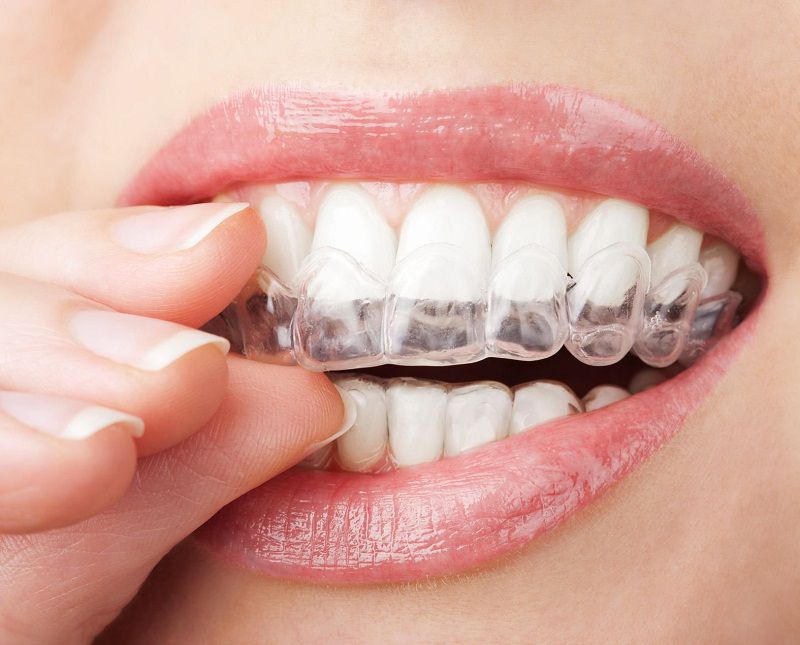 Phương pháp niềng răng này có rất nhiều ưu điểm vượt trội