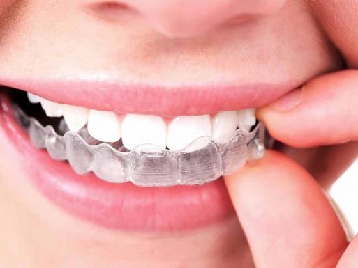 Niềng răng vô hình là gì? Chi phí và hiệu quả mang lại