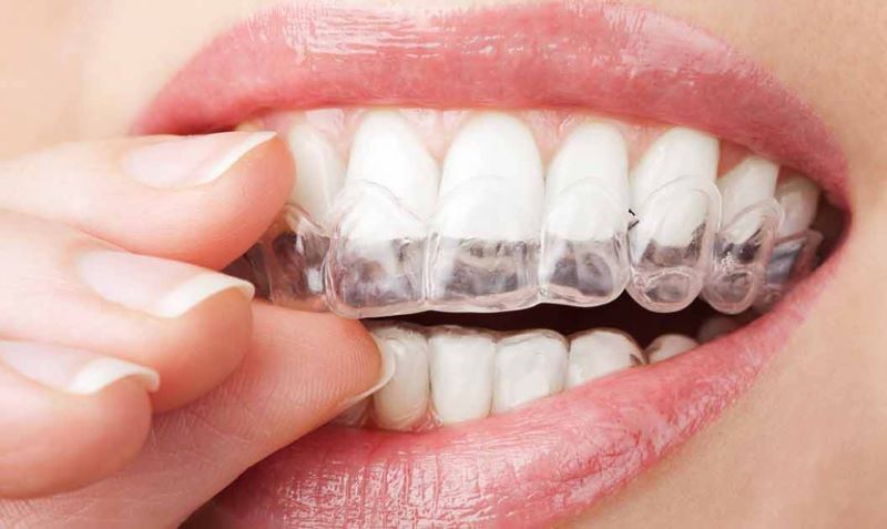 Bọc sứ cũng là một trong những biện pháp điều trị răng hô nặng được nhiều người áp dụng 