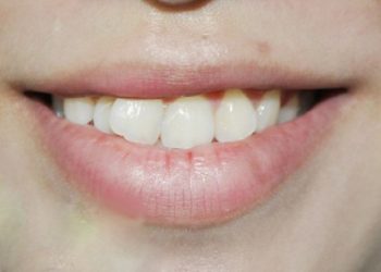 Răng lệch nhân trung là gì? Nguyên nhân gây nên tình trạng lệch nhân trung