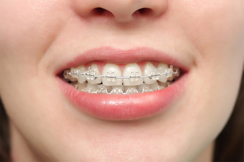 Một số giải pháp niềng răng cải thiện răng lệch nhân trung hiệu quả