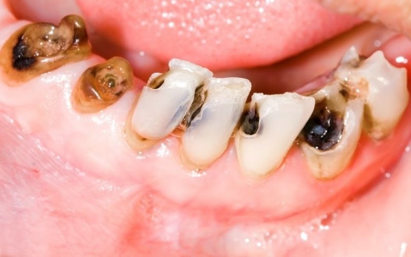 Sâu răng xảy ra ở mọi đối tượng, mọi độ tuổi