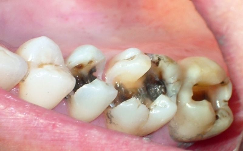 Sâu răng có thể gây nên những biến chứng nghiêm trọng đến sức khỏe và thẩm mỹ