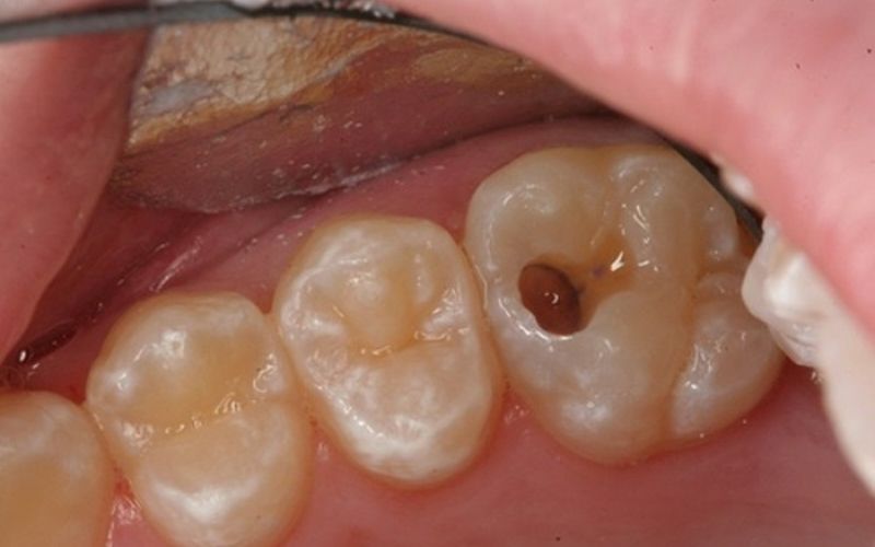 Sâu răng bắt đầu bằng các lỗ nhỏ, dần lớn hơn và có màu sắc lạ