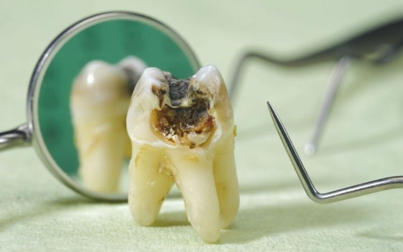 Trường hợp răng bị sâu nặng có thể phải chỉ định nhổ bỏ, tránh những biến chứng nguy hiểm hơn