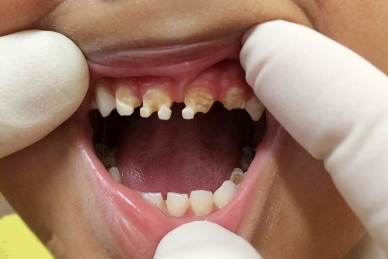 Nguyên nhân trẻ bị sún răng rất đa dạng