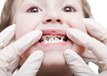 Bệnh sún răng ở trẻ em: Nguyên nhân và cách phòng tránh hiệu quả