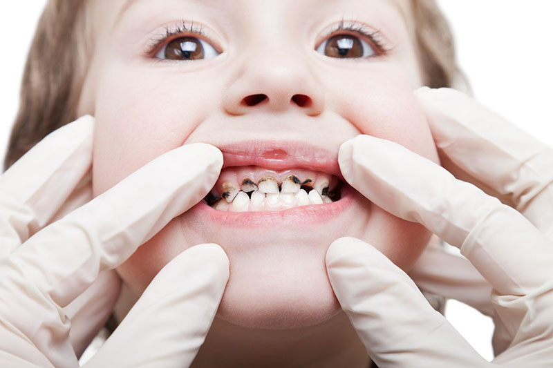 Răng sún đen là tình trạng phổ biến ở trẻ nhỏ