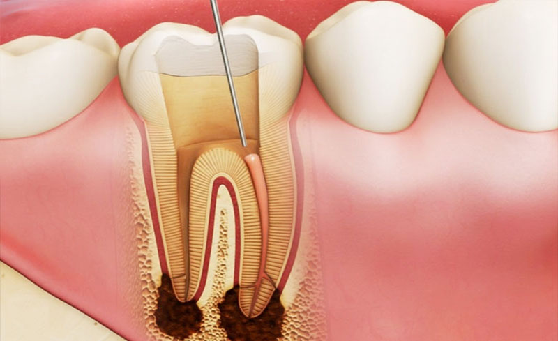 Niềng răng có thể gây chết tủy răng.