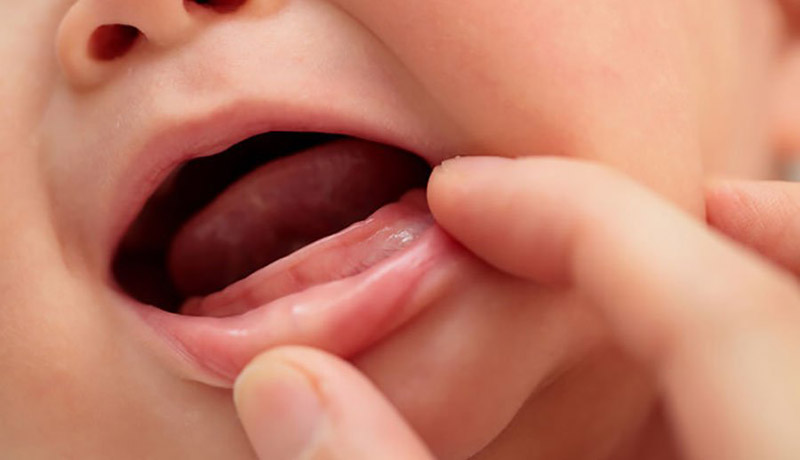 Trẻ bị coi là mọc răng chậm nếu 12-13 tháng tuổi chưa có chiếc răng sữa đầu tiên