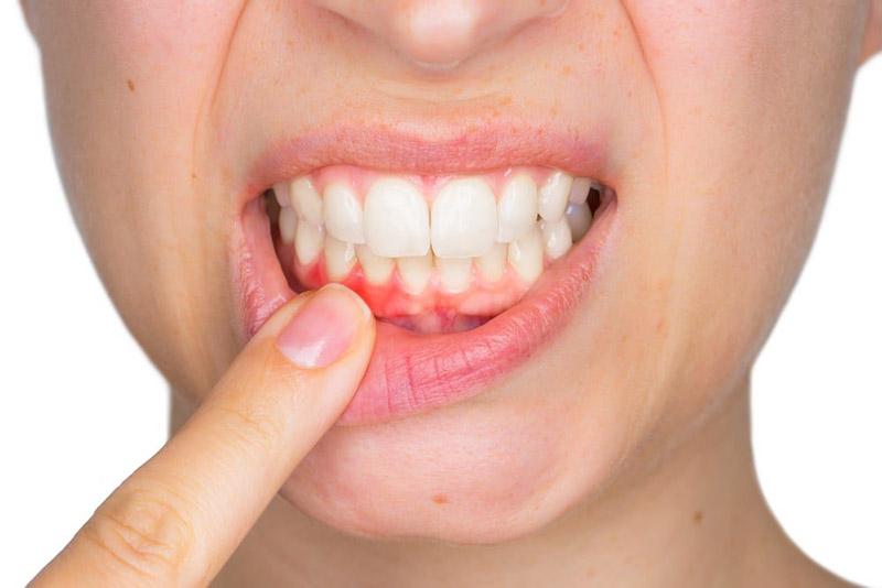 Viêm nha chu là vấn đề răng miệng rất phổ biến
