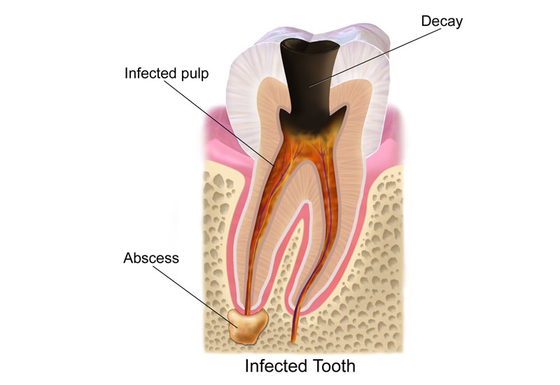 Có rất nhiều nguyên nhân dẫn tới áp xe nướu răng