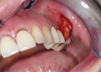 80% trường hợp bị áp xe quanh chóp răng bắt nguồn từ sâu răng