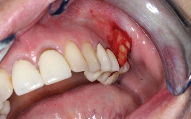 80% trường hợp bị áp xe quanh chóp răng bắt nguồn từ sâu răng