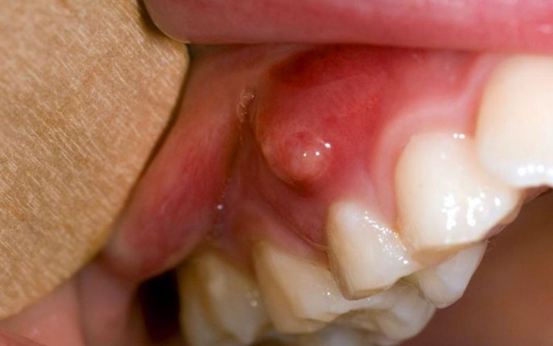Áp xe có thể lan rộng ra các vùng xung quanh và gây nguy cơ mất răng, tử vong