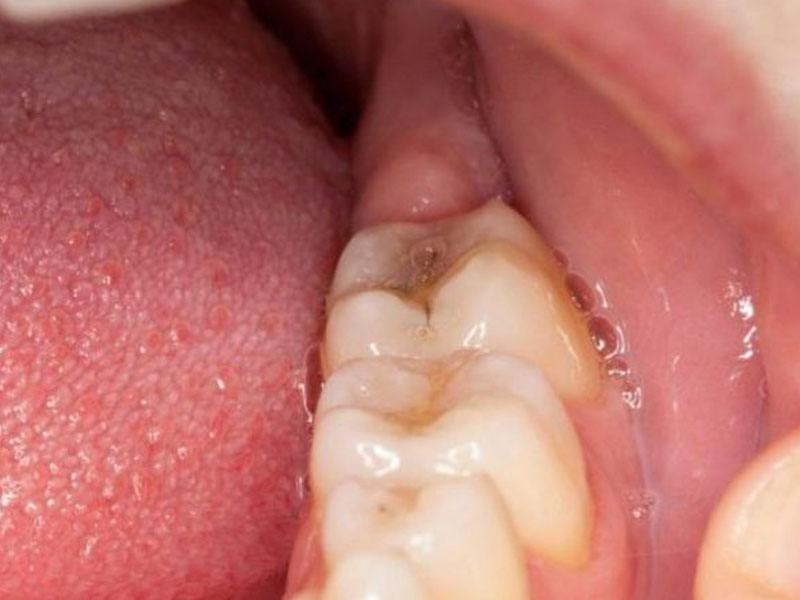 Áp xe răng khôn được nhận biết bằng việc khoang miệng xuất hiện các vết phồng to như phỏng nước