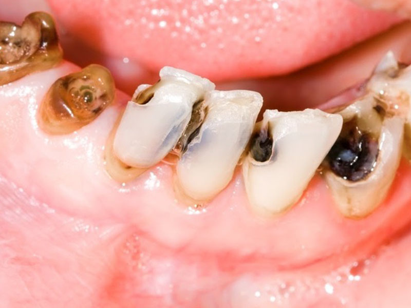 Áp xe răng không cũng có thể xảy ra do biến chứng của bệnh sâu răng kéo dài