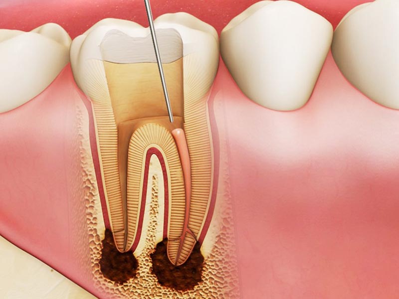 Áp xe răng khôn gây ảnh hưởng trực tiếp tới cuộc sống của bệnh nhân
