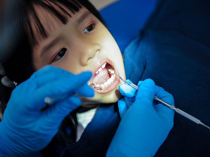 Áp xe răng ở trẻ em là tình trạng nhiễm khuẩn tại chân răng