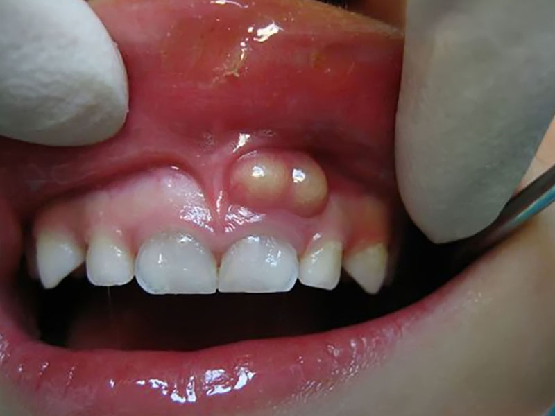 Xuất hiện vết sưng đỏ ở chân răng là dấu hiệu nhận biết của bệnh