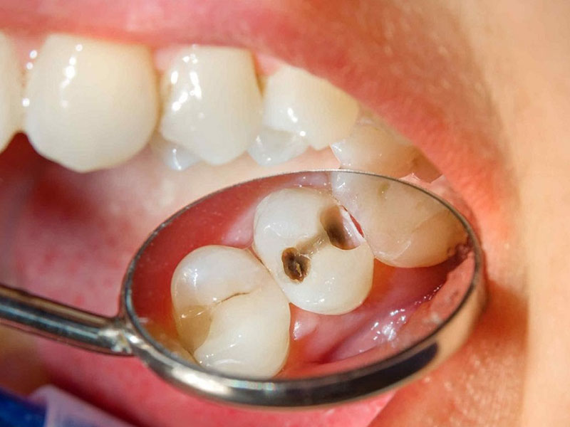 Sâu răng không được điều trị sẽ khiến vi khuẩn tấn công làm áp xe răng