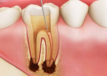 Áp xe răng số 6, số 7 có thể xảy ra ở bất kỳ độ tuổi nào