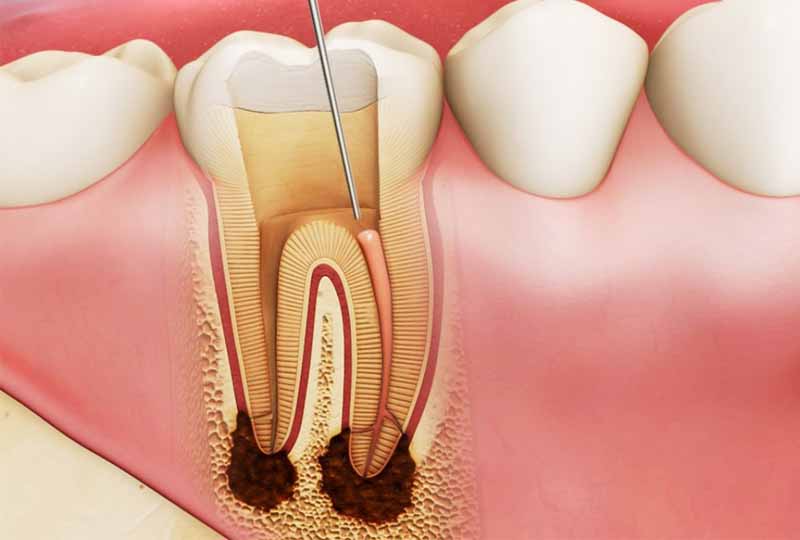 Áp xe răng số 6, số 7 có thể xảy ra ở bất kỳ độ tuổi nào