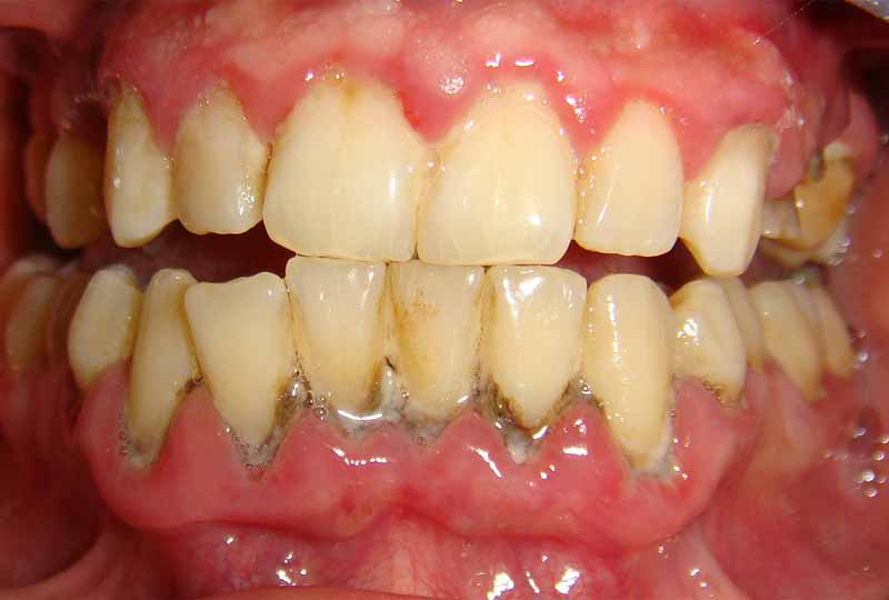 Viêm nha chu là bệnh lý răng miệng phổ biến thường gặp