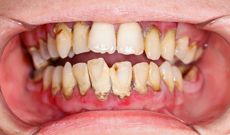 Bệnh viêm nha chu không chỉ huỷ hoại hàm răng của trẻ mà còn ảnh hưởng tới sức khoẻ toàn thân.