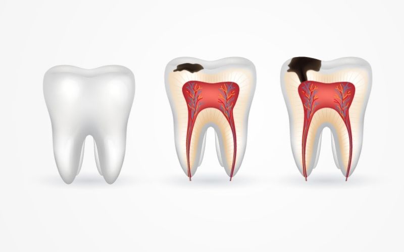 Sâu răng diễn biến theo nhiều cấp độ từ nhẹ đến nặng