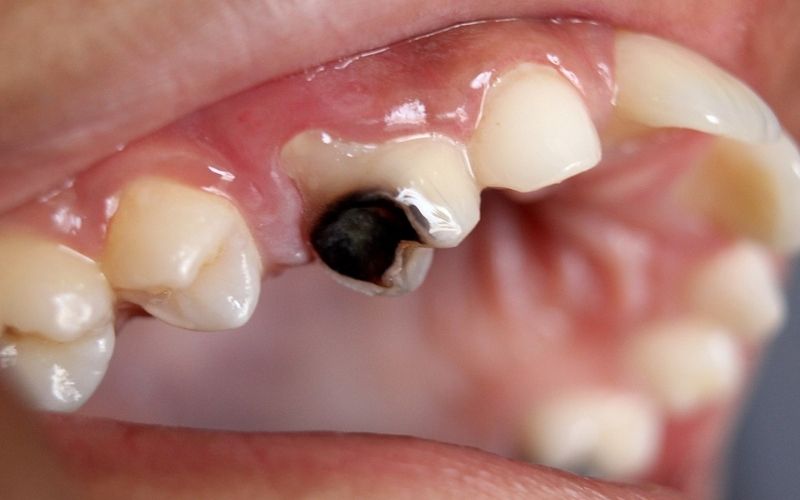Sâu răng nặng khiến răng bị phá hủy và không thể phục hồi